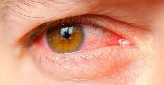 आंख आने या लाल पड़ जाने पर(Allergic Conjunctivitis)